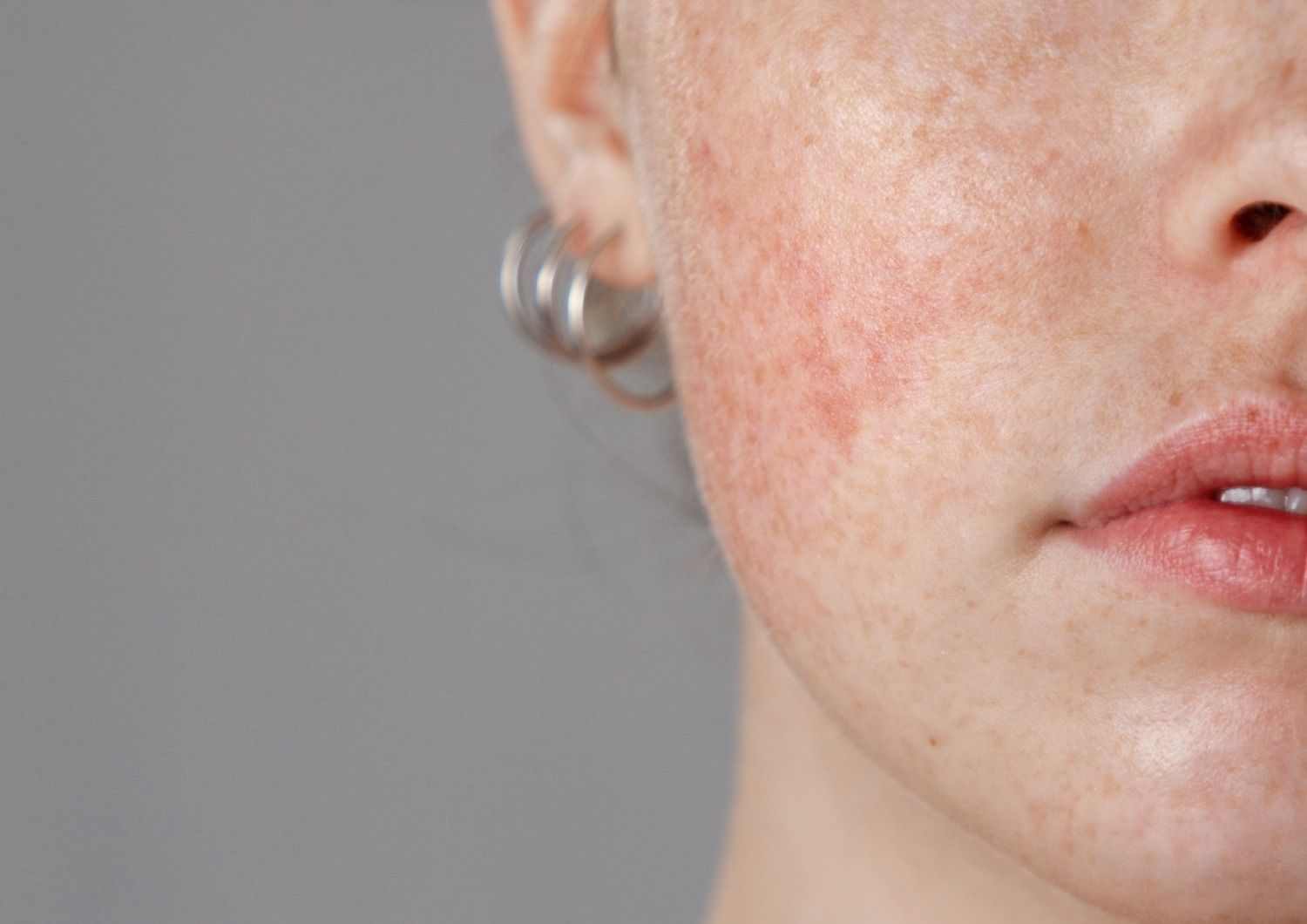 Rosacea and unsightly vessels