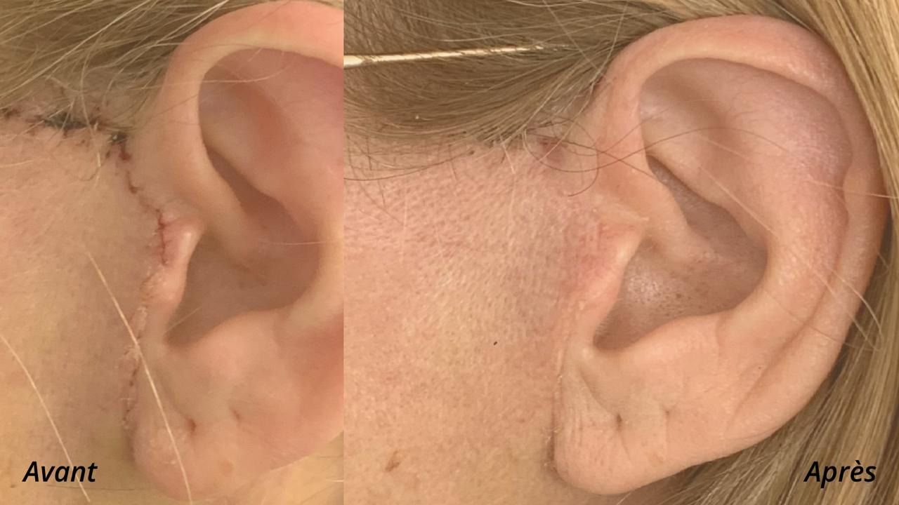 Cicatrisation après une chirurgie esthétique