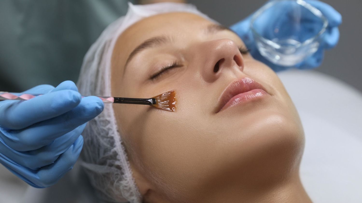 Peeling profond au phénol : avantages, protocole, risques