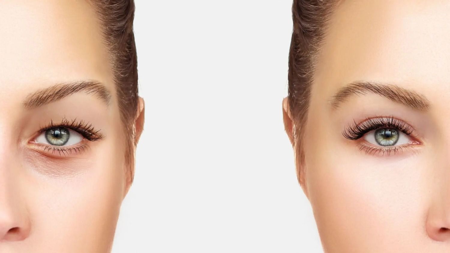 Présentation de la Blépharoplastie