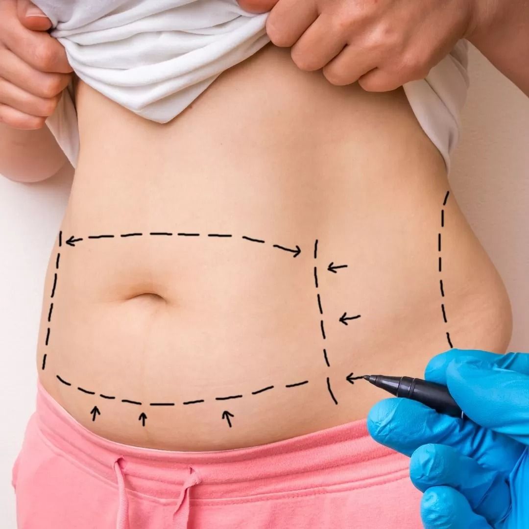abdominoplasty