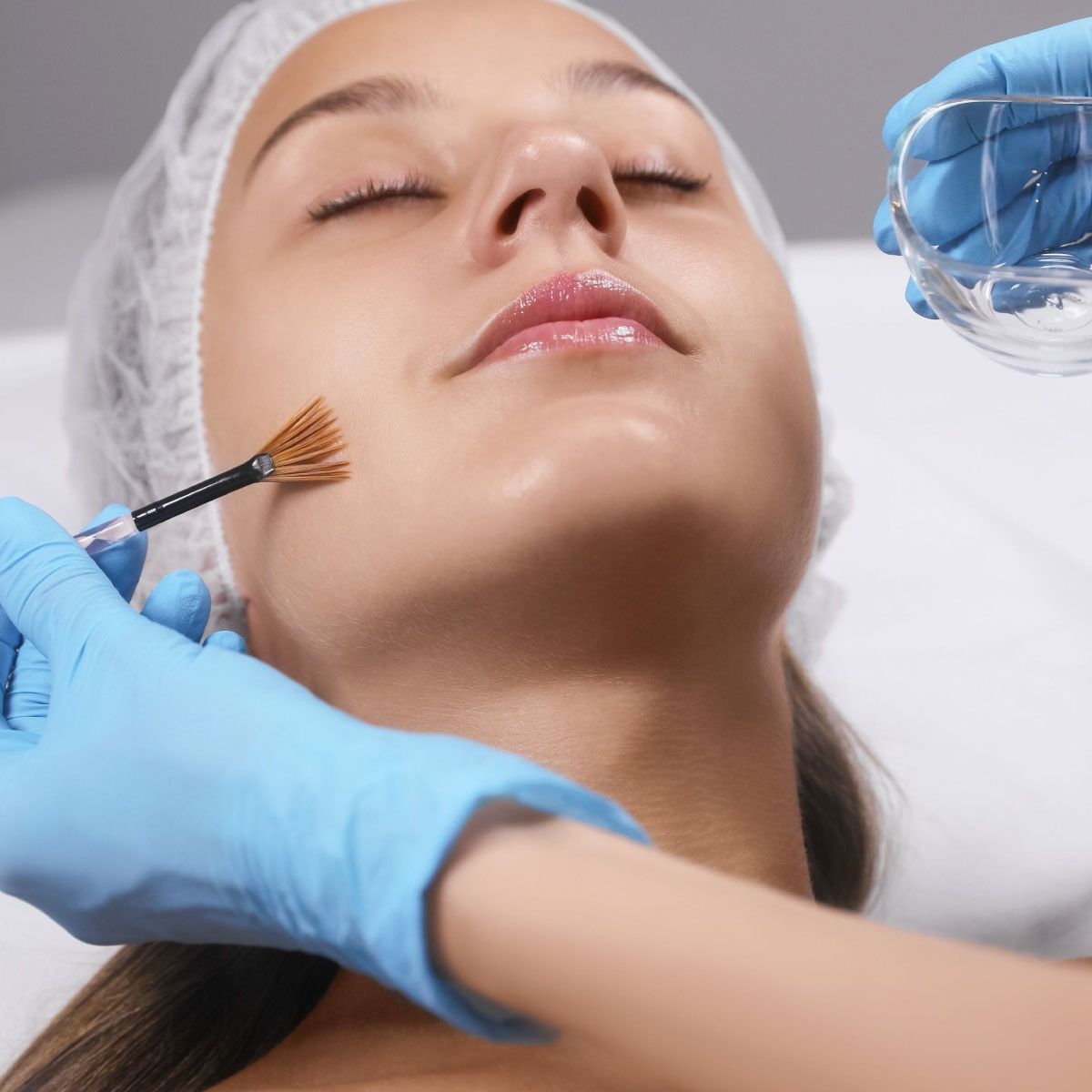 peeling_profond_au_phenol