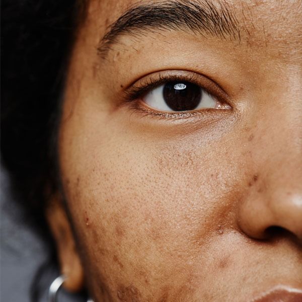 taches_pigmentaires_et_melasma_comment_les_reconnaitre_et_les_traiter_