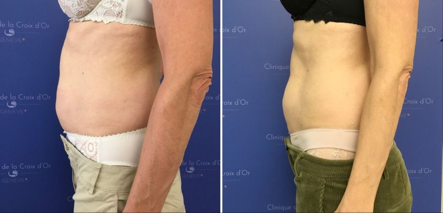 les_differences_entre_la_liposuccion_et_la_cryolipolyse