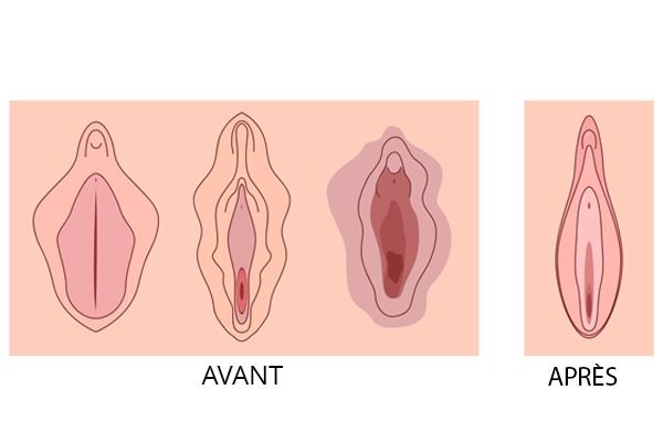 labiaplastie_deroulement_douleurs_et_resultats