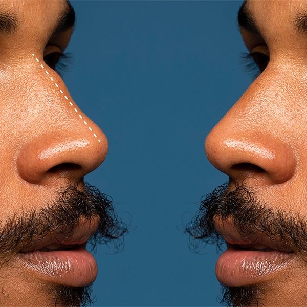 chirurgie_esthetique_chez_l_homme_visage_corps_et_tendances_en_2026_a_geneve