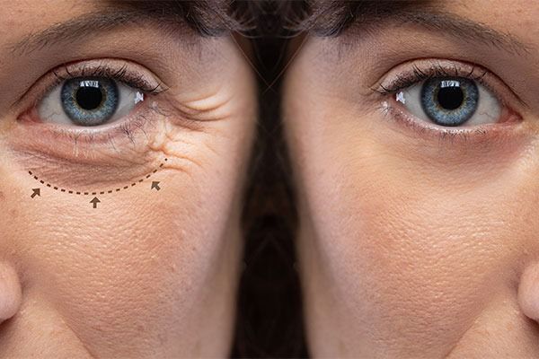 paupieres_tombantes_quand_faut_il_envisager_une_blepharoplastie_ou_operation_des_paupieres