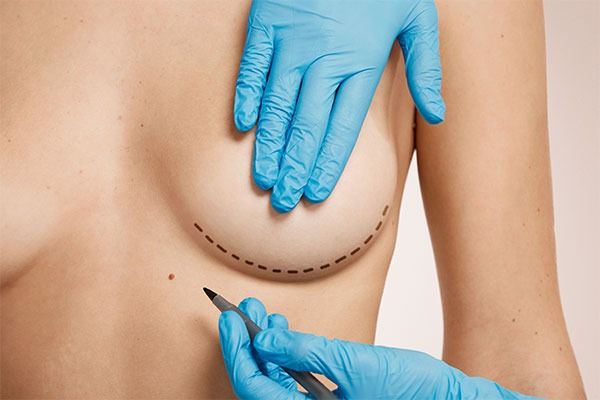 augmentation_mammaire_en_suisse_implants_lipofilling_ou_les_deux_