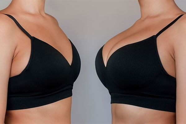augmentation_mammaire_en_suisse_implants_lipofilling_ou_les_deux_