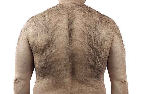 Déroulement de l’intervention pour l’épilation laser homme