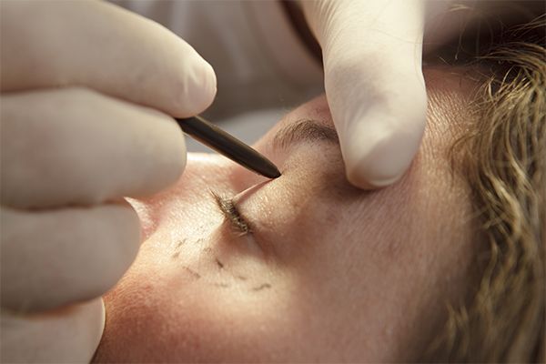 Déroulement de l’intervention pour la Blépharoplastie