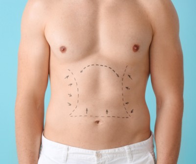 Postoperative follow-up of an abdominoplasty