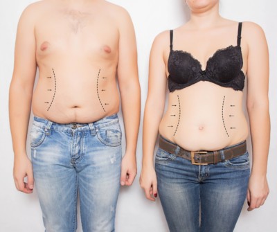 When should you resort to abdominoplasty?