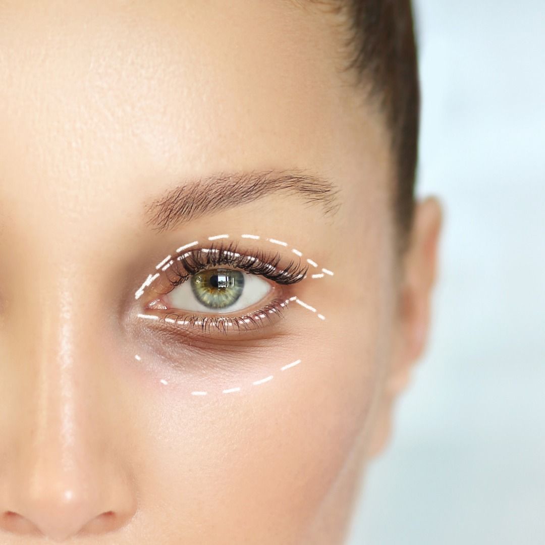 medical blepharoplasty