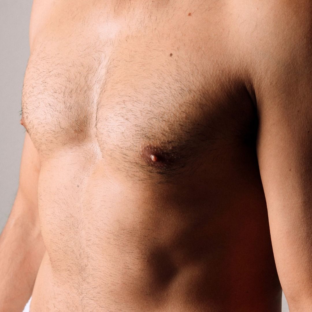 gynecomastia