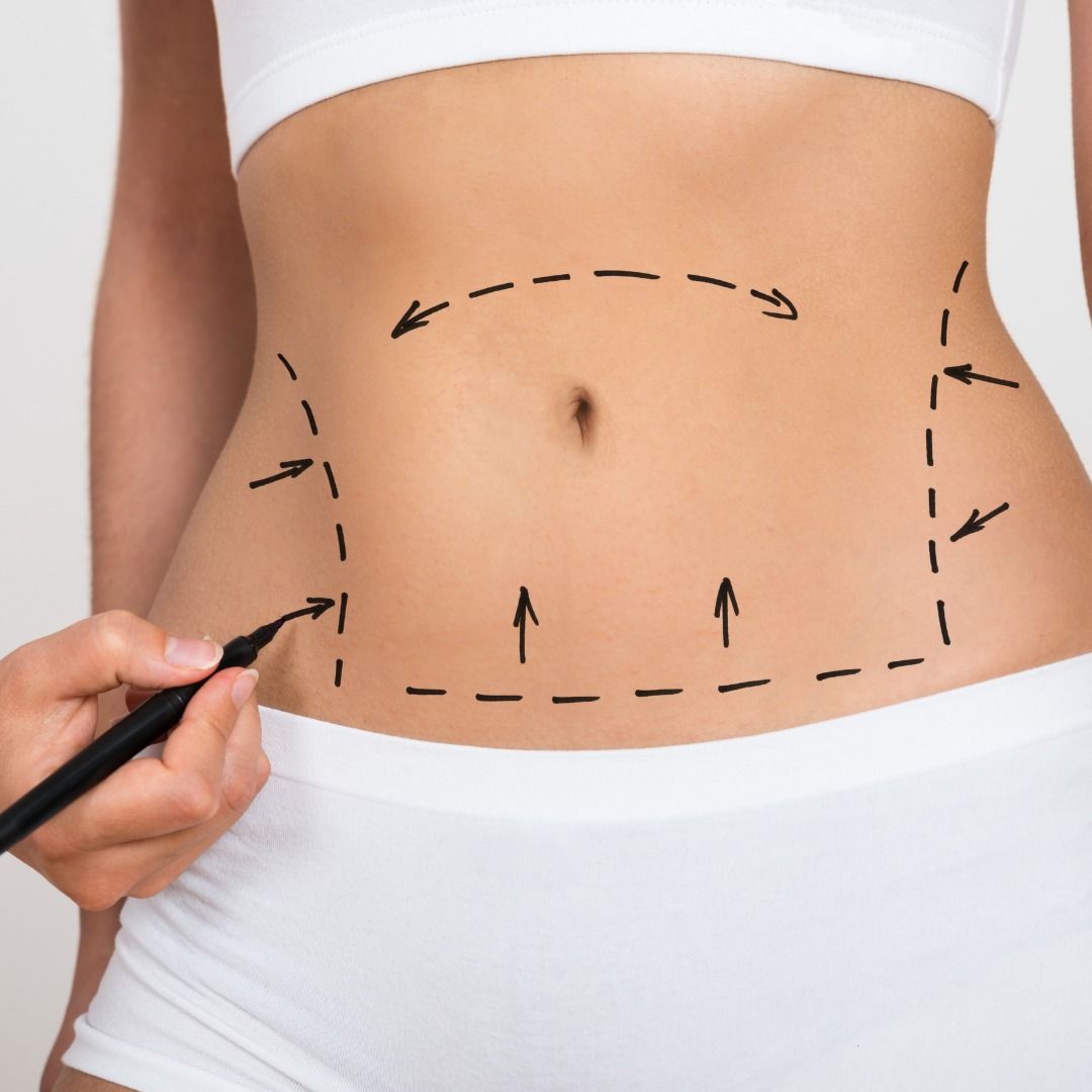 liposuction