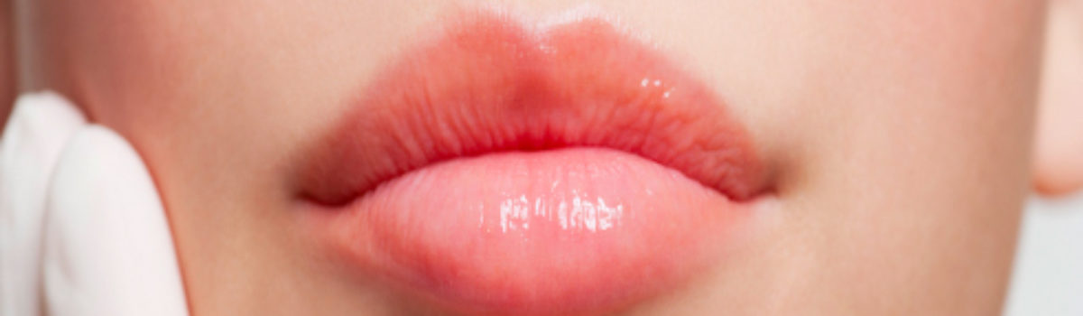 Injection Lèvres : « Oui à une bouche pulpeuse, non au bec de canard ! »