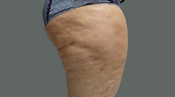 Jambes de femme avant une cryolipolyse